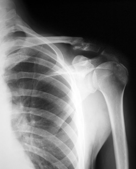 Left Shoulder Xray