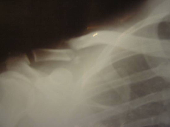 Chad's broken collar bone