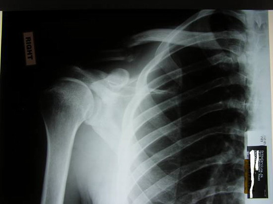 Chad's broken collar bone