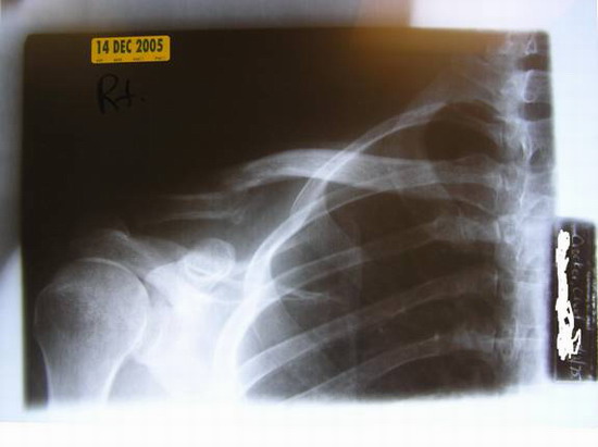 Chad's broken collar bone